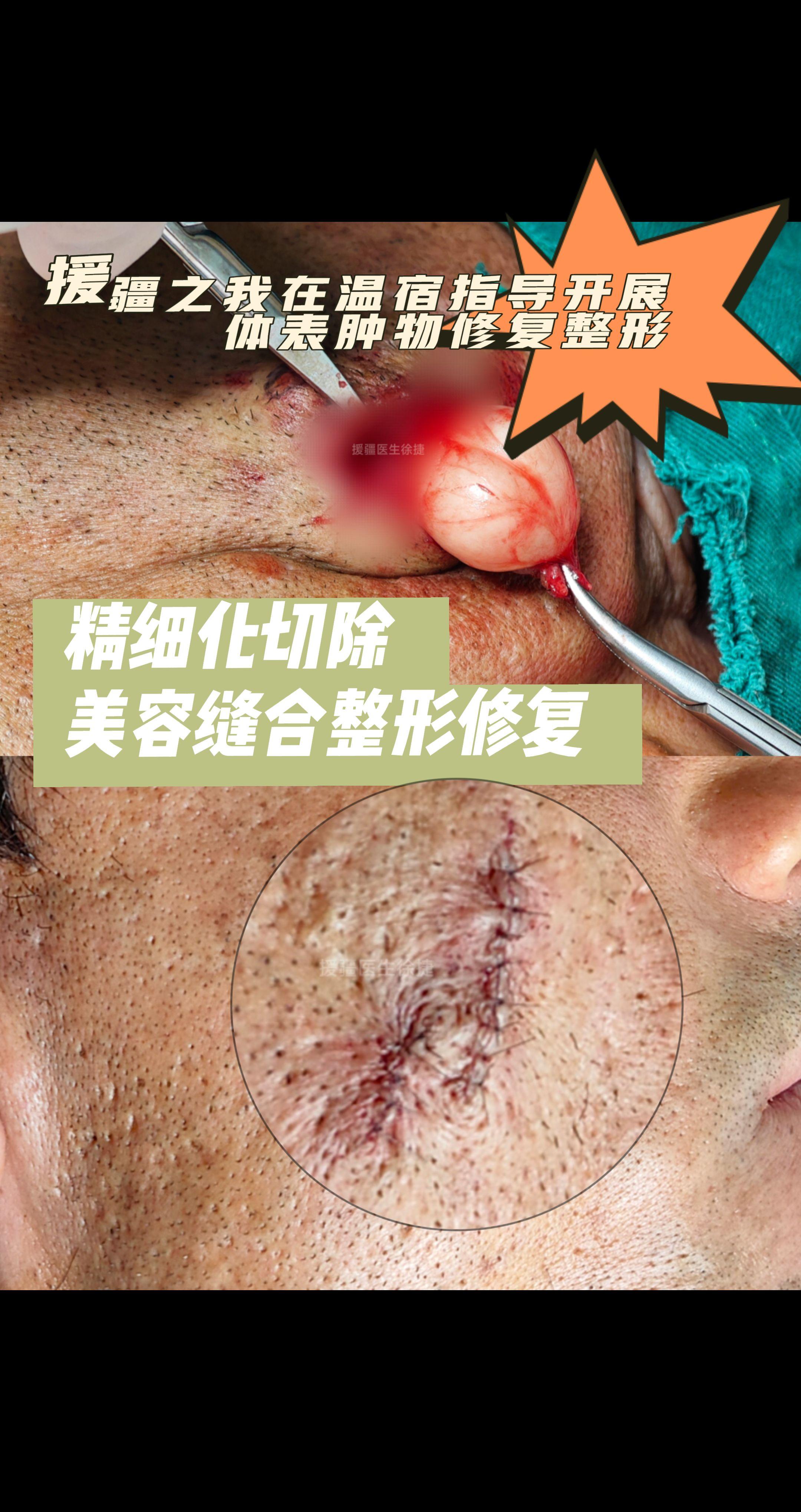 援疆之我在温宿指导开展体表肿物修复整形。体表肿物精细化切除+美容缝合+...