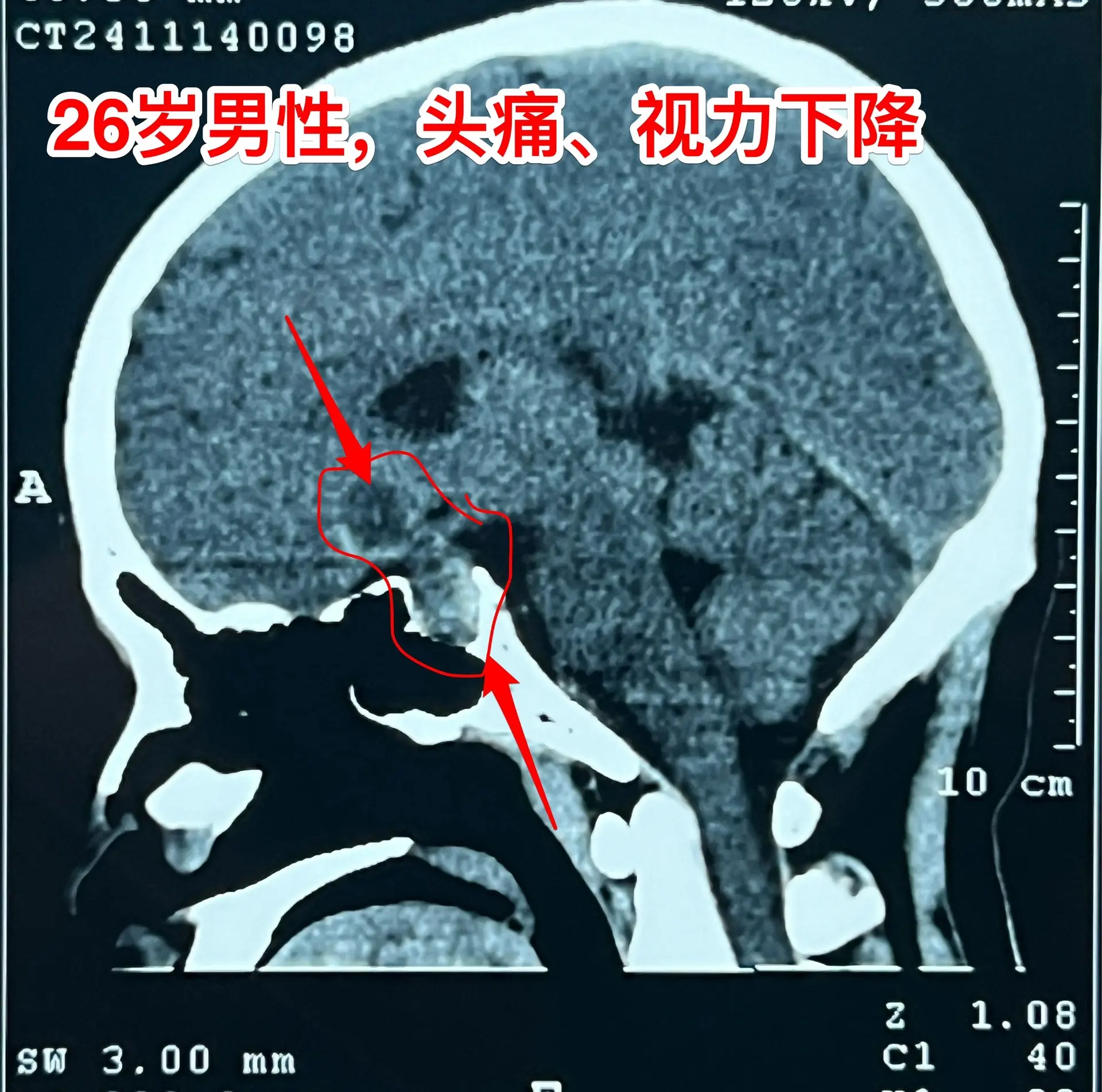 拉克氏囊肿的症状有时和颅咽管瘤是一样的。拉克氏囊肿不是真正的肿瘤，但是...