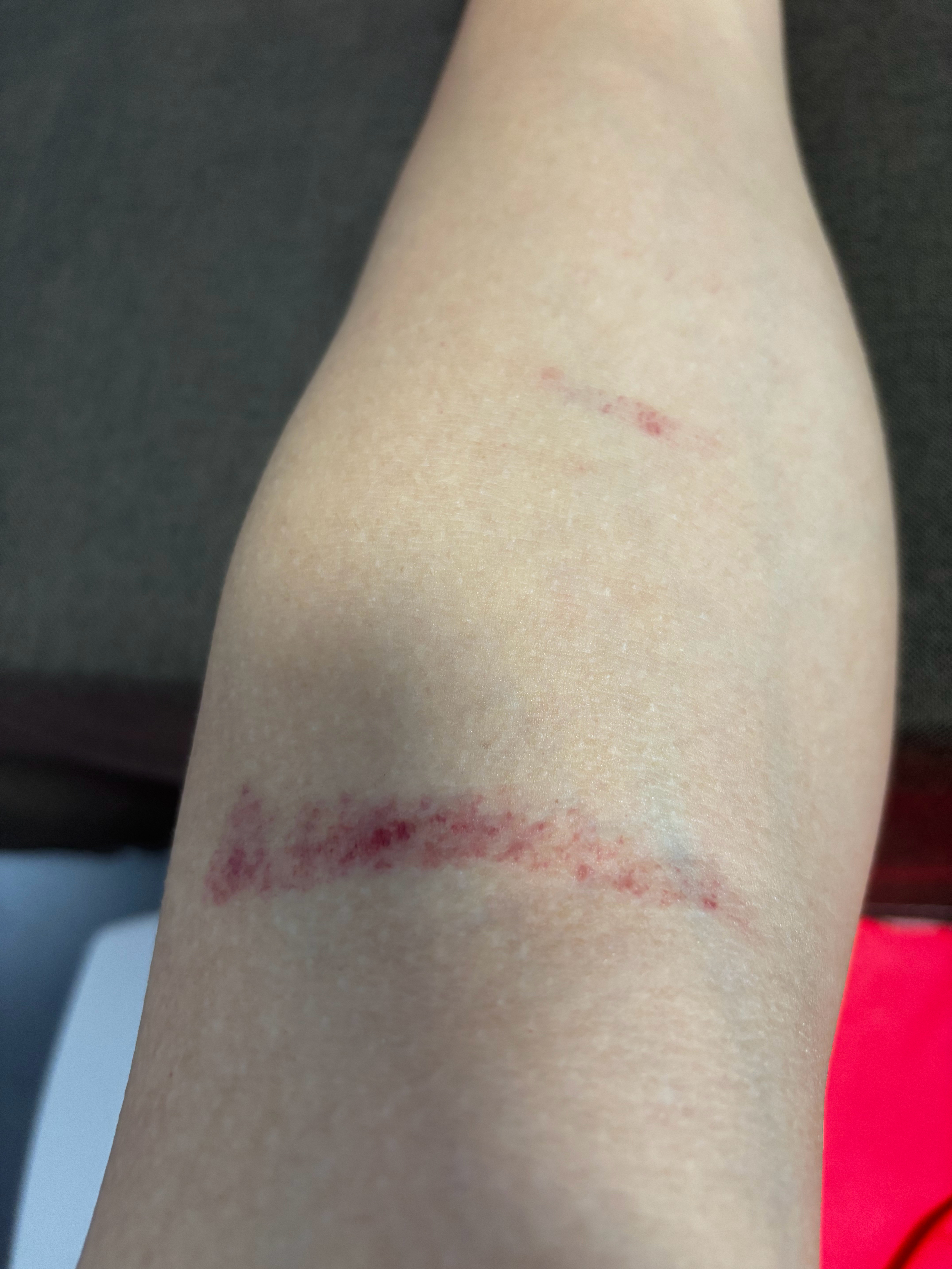 晚上打球被抓成这样了 