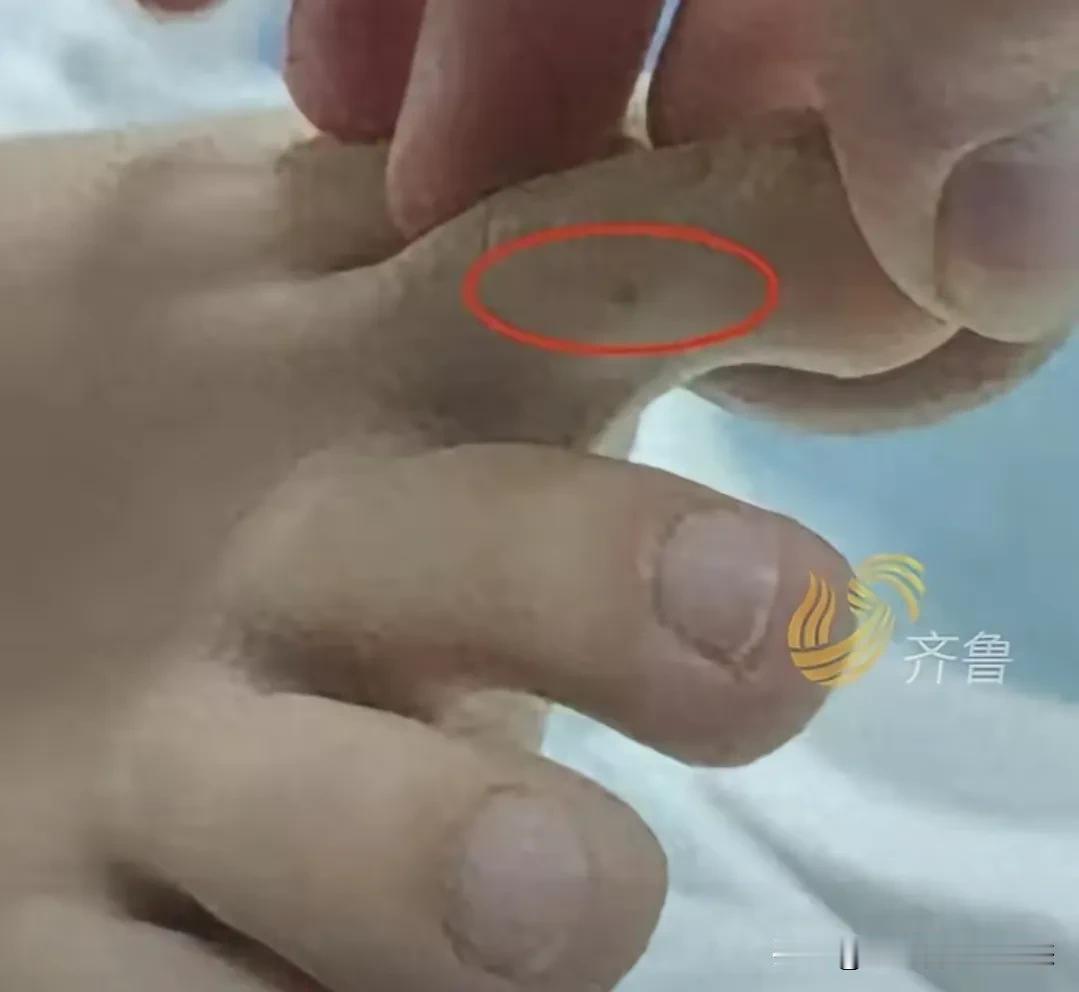 惊闻一 27 岁风华正茂的年轻女子在三亚旅游，被不明动物咬伤，就医后医生居然毫无