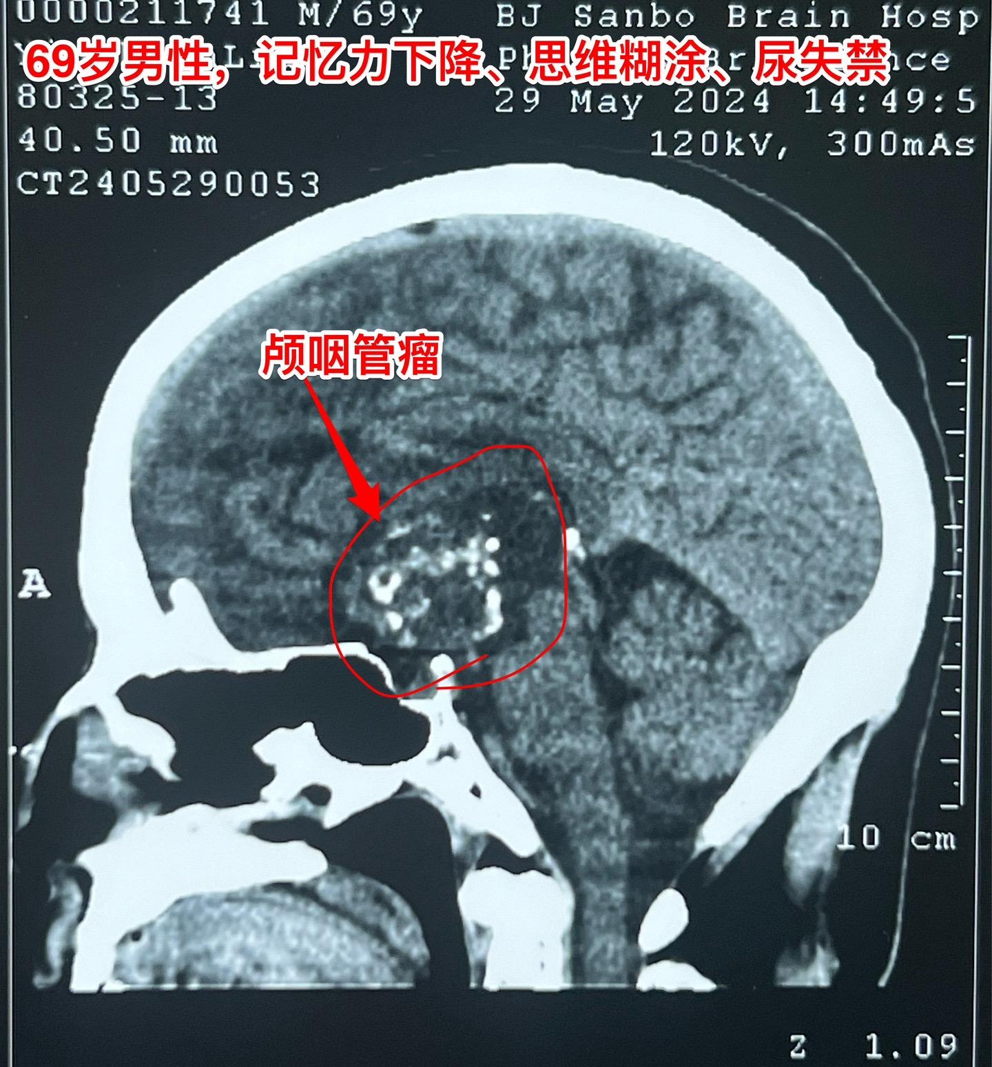 69岁发现颅咽管瘤还能作手术吗？69岁的南通市老人近半年出现记忆力差、糊涂。4月份出现尿失禁，到医院检查才发现病根儿是颅咽管瘤，肿瘤体积大，导致了脑积水。第一步在当地医院先作了脑室-腹腔分流术，治疗脑积水，尿失禁的症状有改善。
       但是老人的身体很虚弱。还不能下地行走。这样的身体状态是不能承受切除颅咽管瘤这样的大手术的。
        老人的女儿随后和我加后，我给予老人补充激素后，老人的身体状况才逐步改善，慢慢地能下地走路了。
        不能不佩服这家人的勇气和爱心[强][强]！