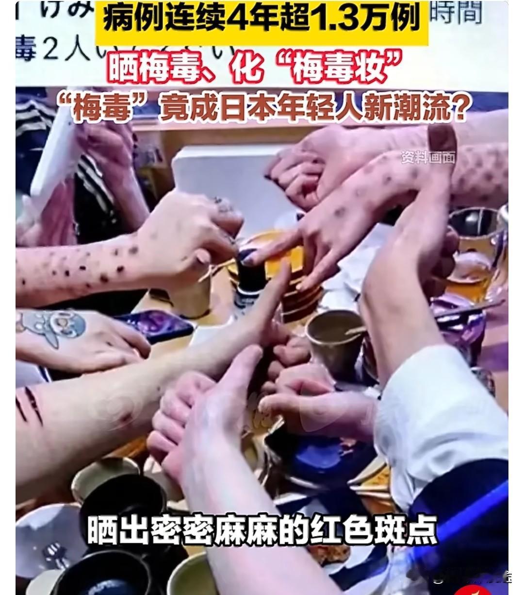 “日本梅毒正盛行”还敢去日本吗？1月6日报道，日本梅毒感染人数近年持续处于高位，