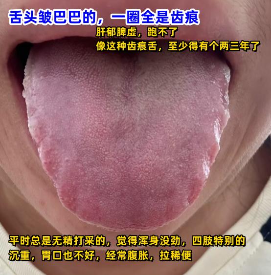 今日舌诊案例分析[给力][给力][给力]
1.整体看舌面水滑，舌质暗紫，舌根收缩