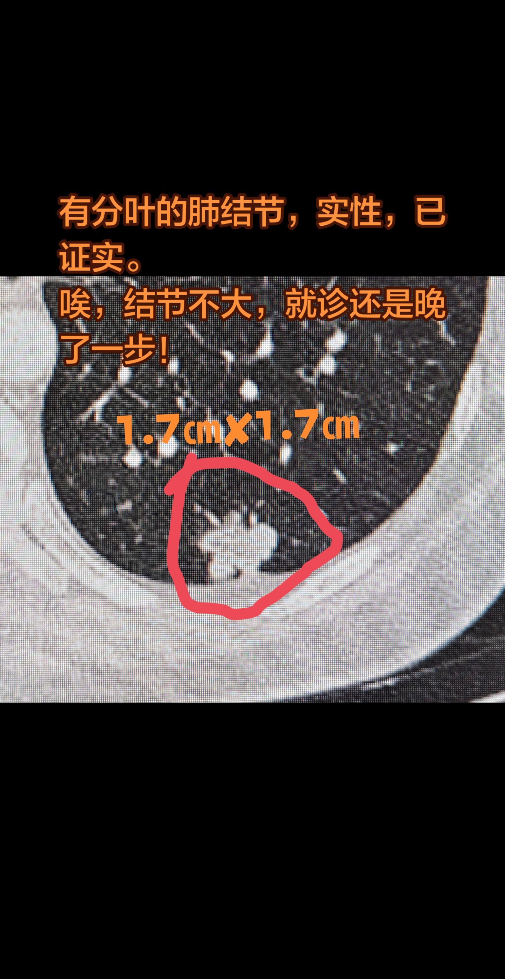 有分叶的肺结节，考虑恶性吗。分叶是恶性结节的常见征象之一，但单凭这一特...