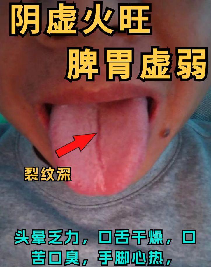 裂纹舌脾虚 大总结 快进来看看