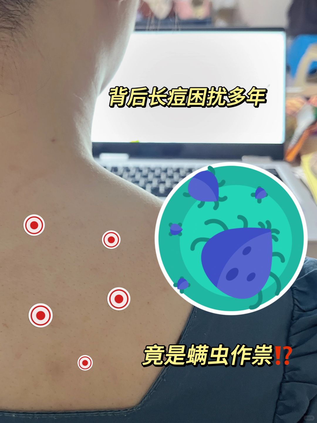 背后长痘困扰多年，结果是螨虫在作祟！！