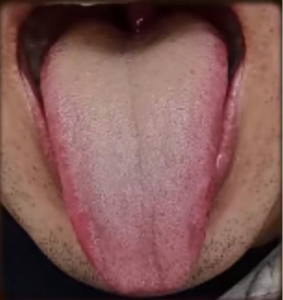 舌根凹陷，舌苔黄厚，舌质发红，中焦和下焦湿热这么重，为什么吃药没效果？



患