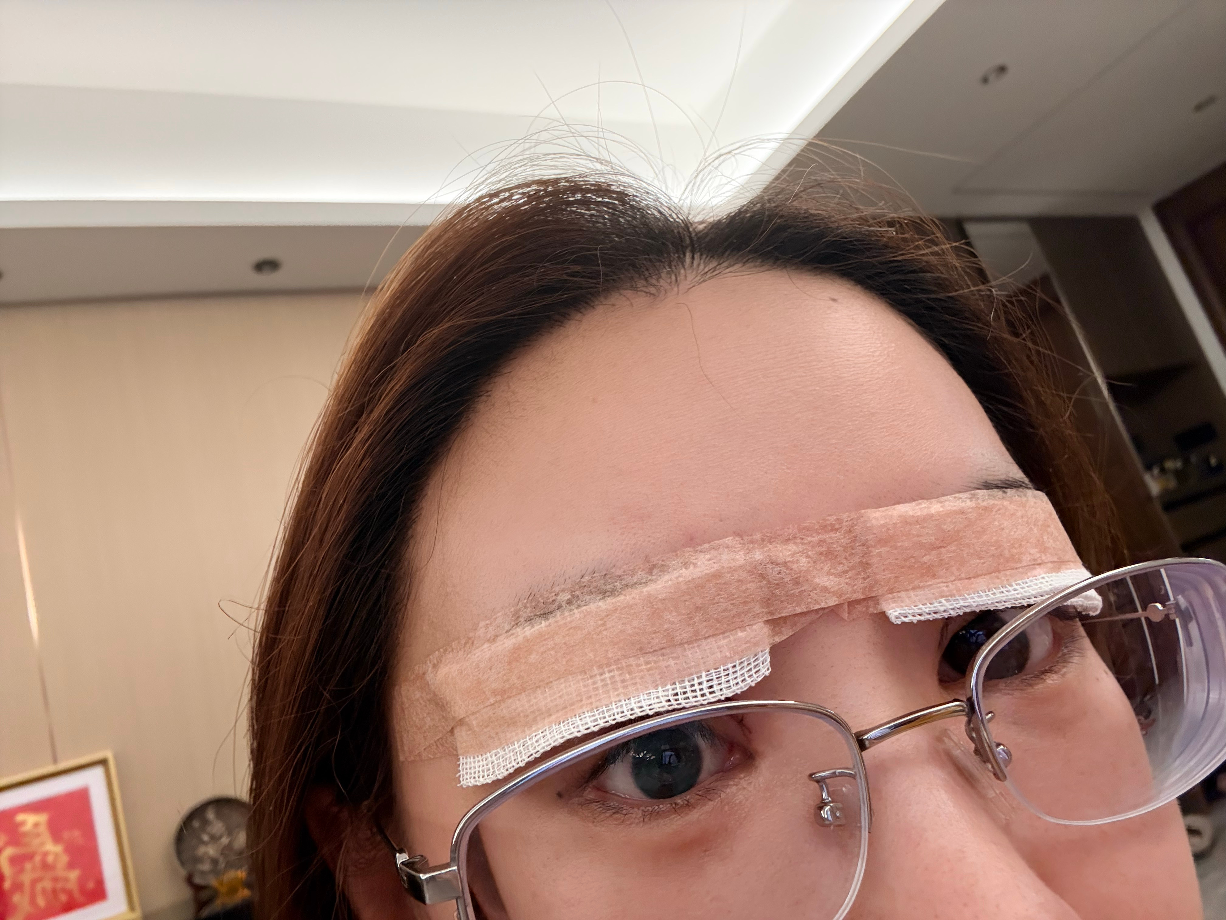 终于告别了这个让我普了两年的超窄双眼皮今天大白问我，这两年我是不是特别恨他为什么