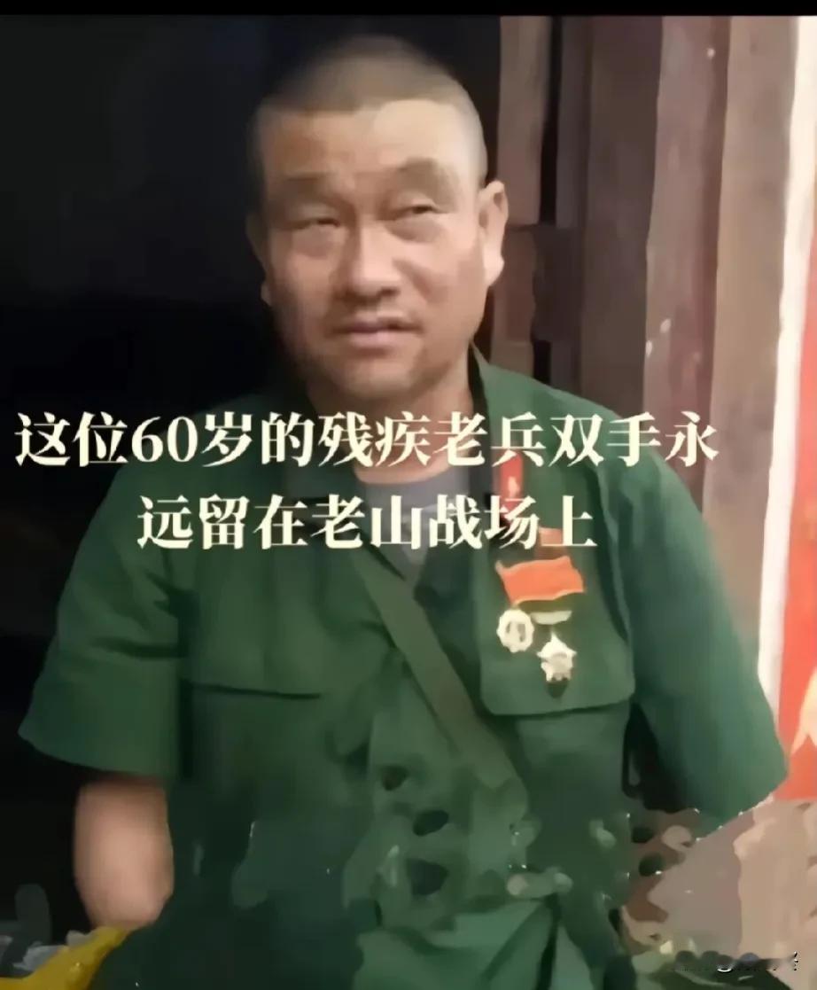 他是14军40师118团1营2连战士谢圆跃，1984年4月28日穿插作战时双手被