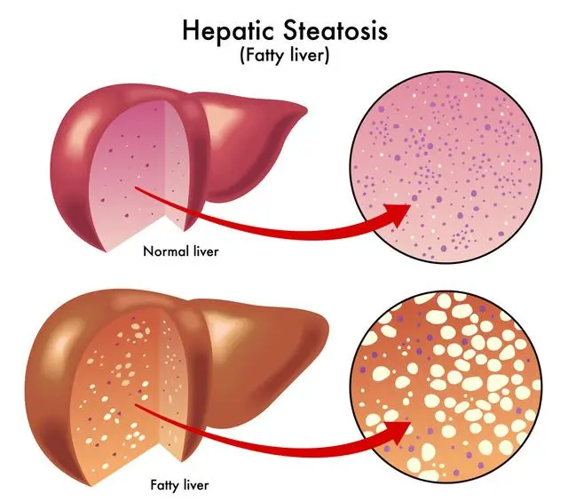 J Hepatol | 中国普通人群的肝纤维化高患病