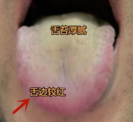 只看舌脉，就是血行瘀阻的证象，再看完舌苔，就知道为什么舌脉增粗，颜色紫黑了！
 