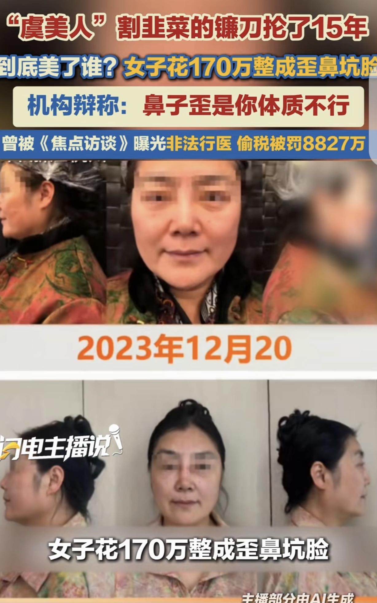 浙江杭州，一54岁女子花170万，跑杭州“某美人”那里去做整容，结果眼睑大小不一
