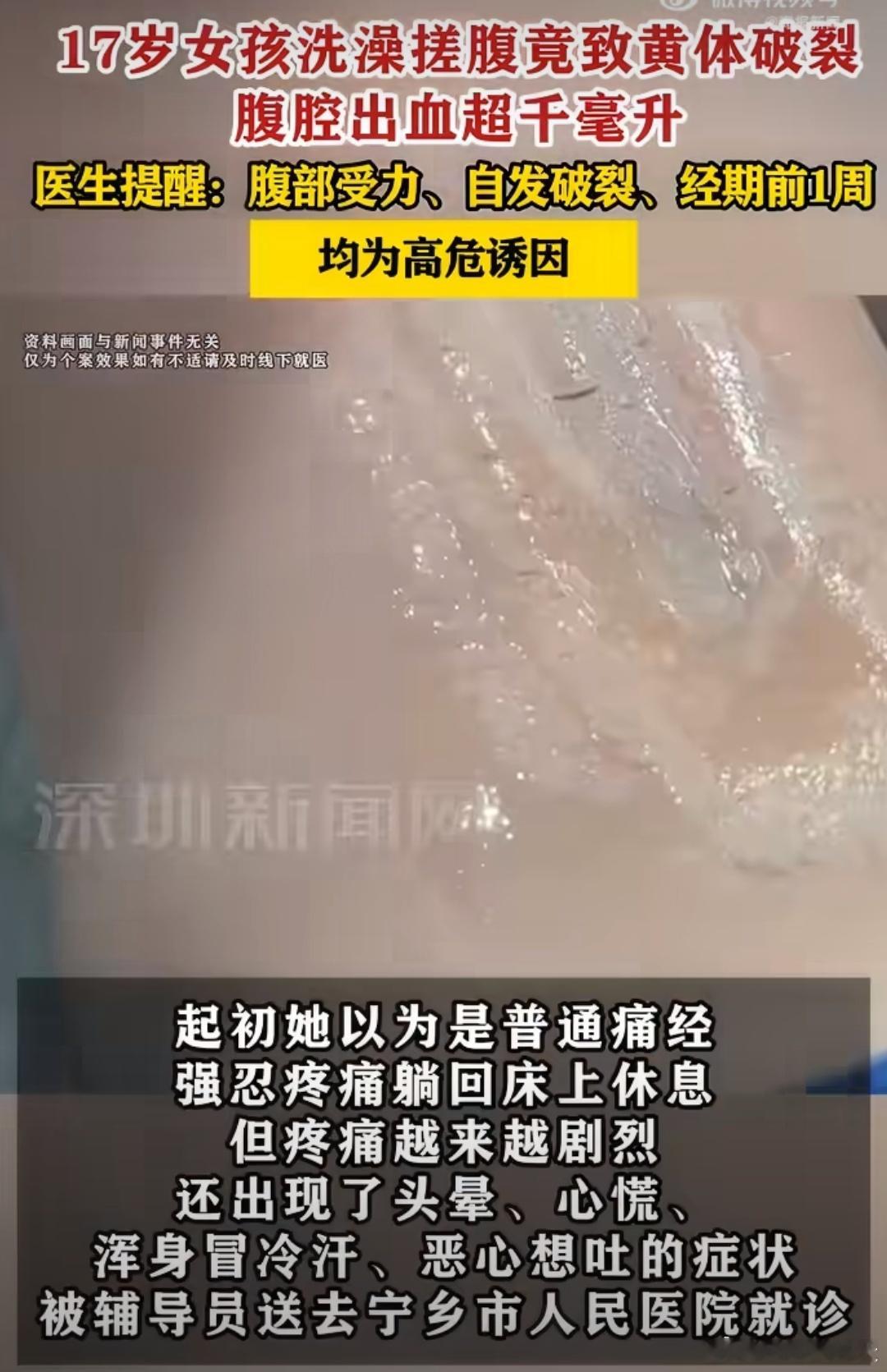 医生回应17岁女孩用力搓澡致黄体破裂这也太可怕啦，要知道这种情况直接威胁到生命安