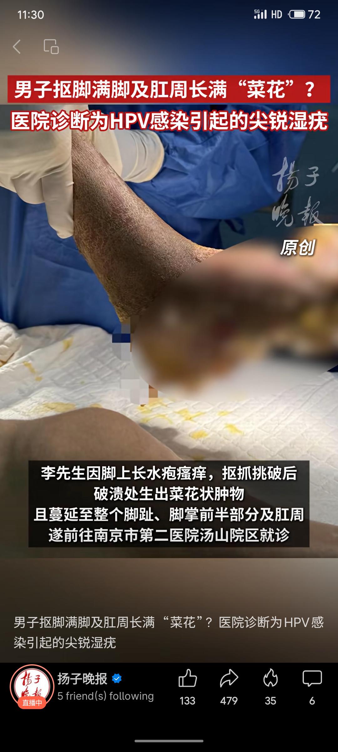 李先生因脚部水疱瘙痒，抠破后伤口处长出“菜花”状疣体，并蔓延至足部及肛周。经医院