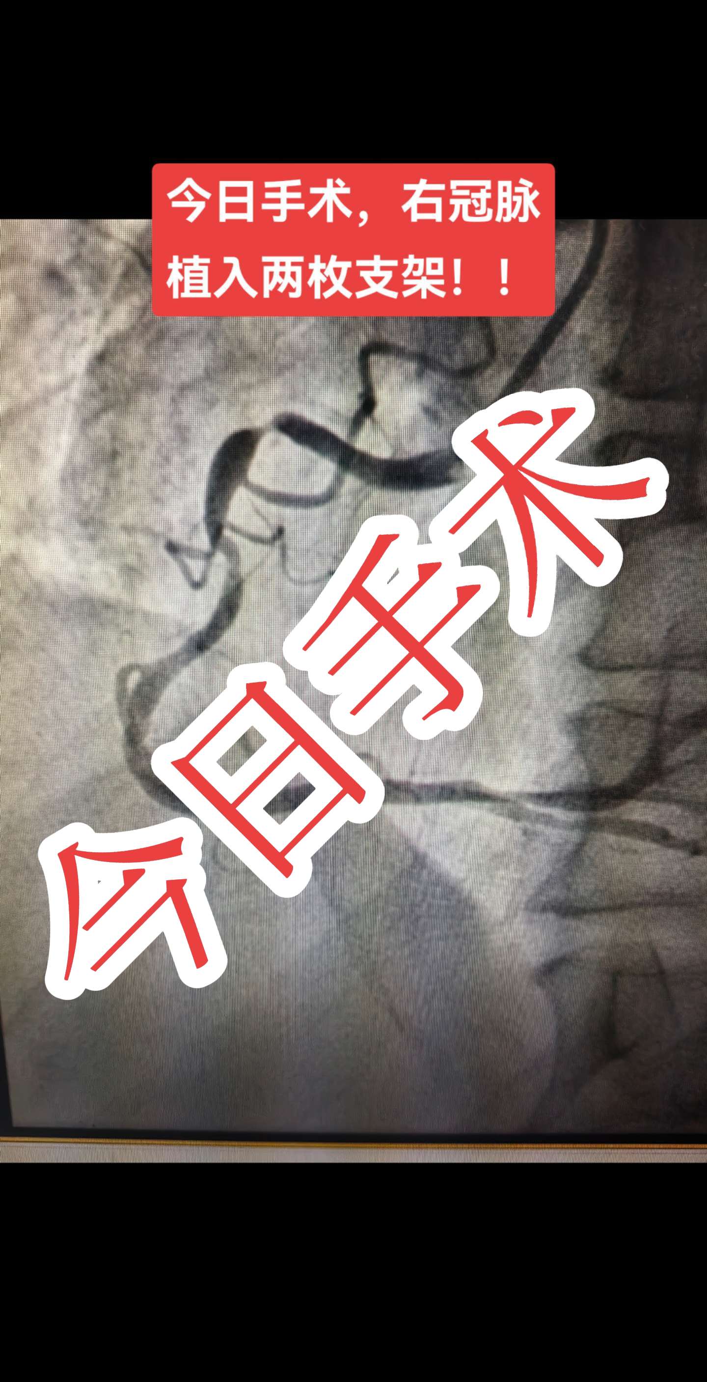 老年男性患者，冠心病、心绞痛，右冠脉支架。