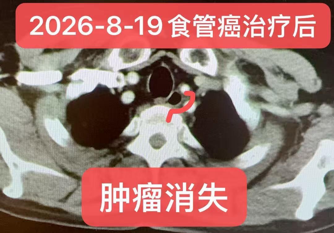 个案分享：一例晚期食管癌的治疗过程。【个案分享】一例晚期食管鳞癌（cT...