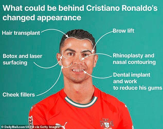 【纽约整形主任：C罗可能花25万整容，包括整牙、隆鼻、植发等】虎扑11月21日讯