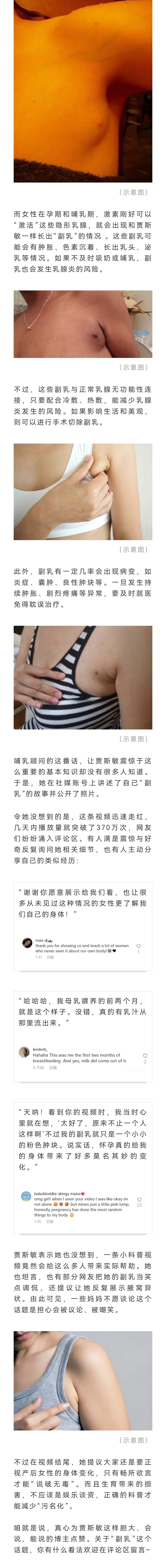 近期，海外一产妇长出第三个胸的新闻引发舆论热议，专家:正常，男女都有 