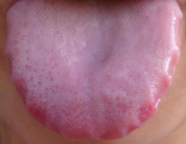 下午继续，伸舌我看！全程不收费！一个不漏，1分钟告知病因和调理方向！齿痕多的像啤