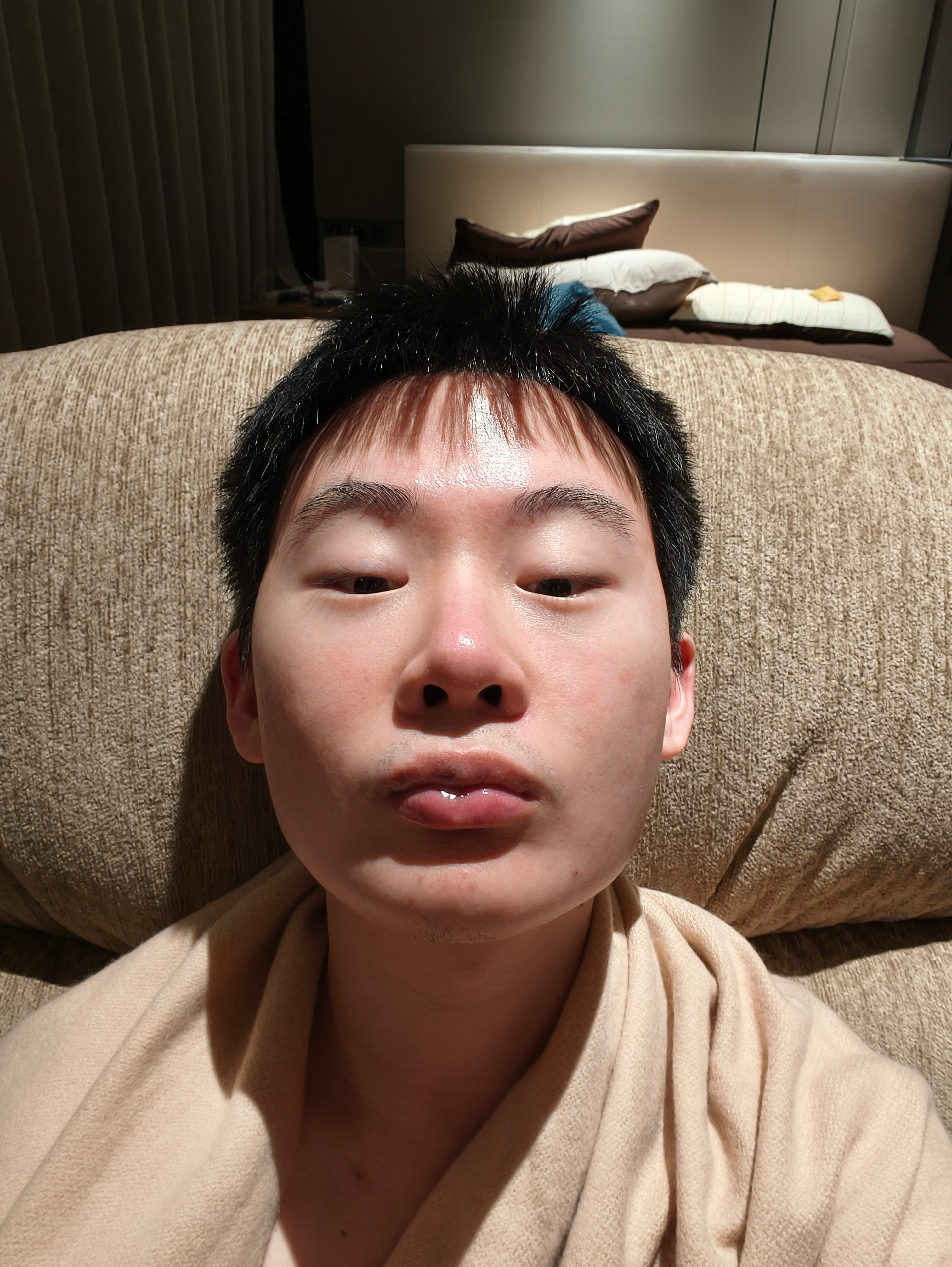 胶原越密集的部位打胶原酶就越痛，术后也越肿胀现在是术后第2天，为了面中更平整，降