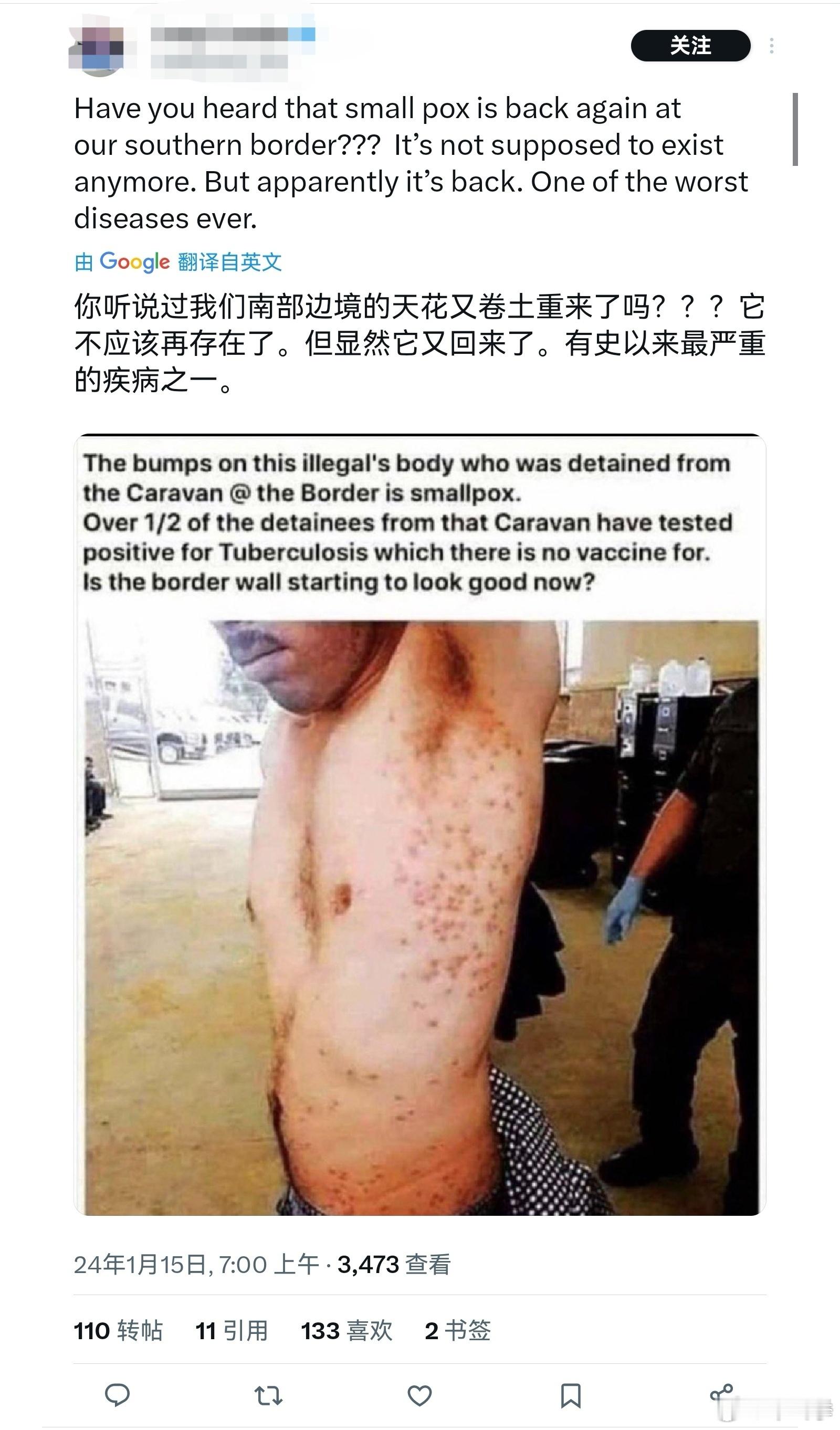 网传美国南部边境天花开始流行…… ​​​