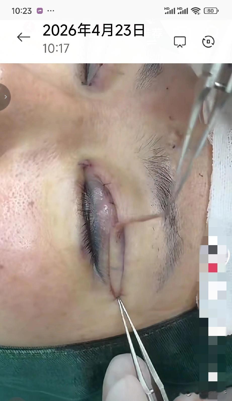 原来双眼皮是这么来的！看着都疼，受不了一点疼的人路过！美是给耐疼的人享受的，我宁