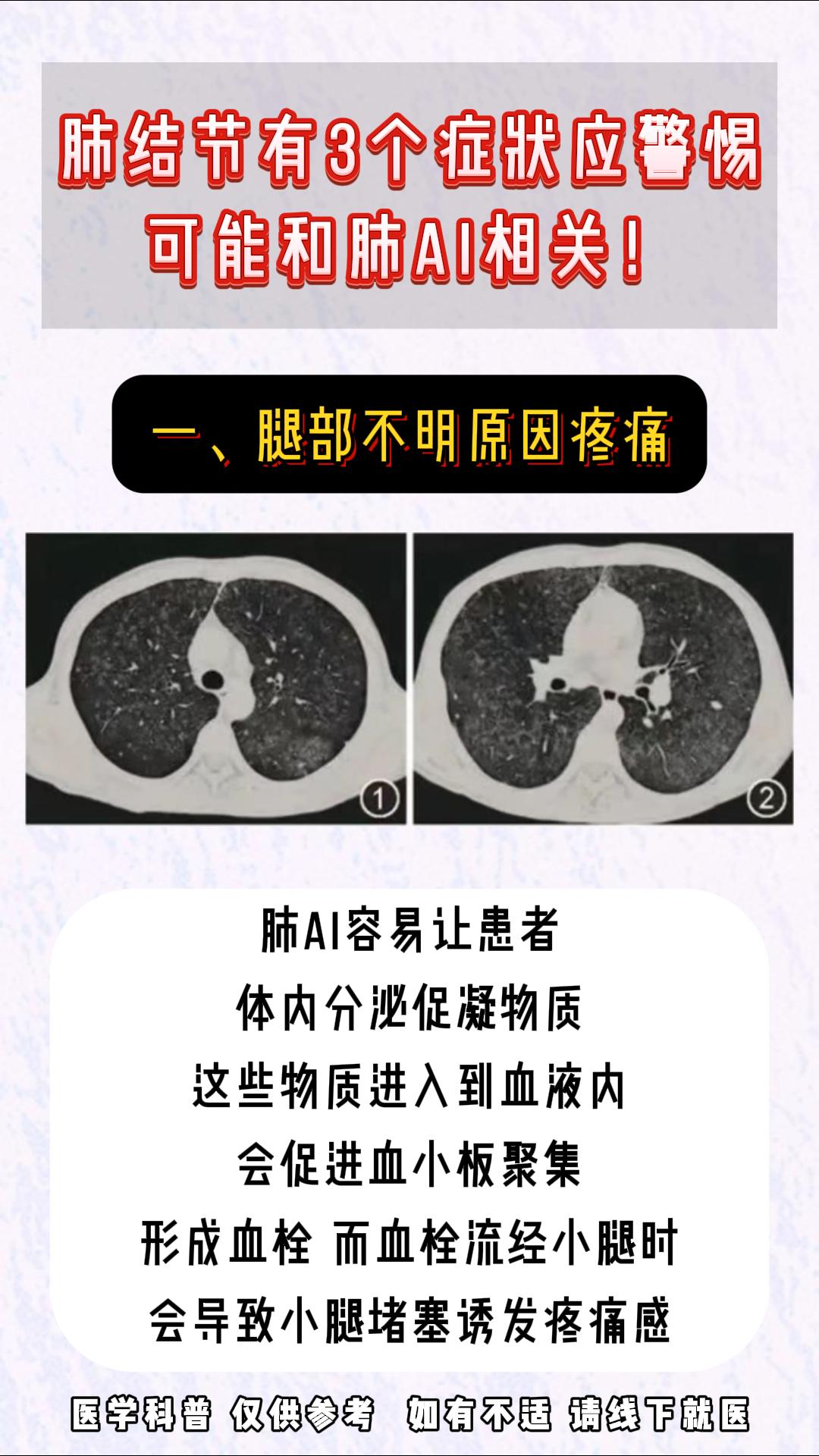 肺结节有3个症状需警惕。