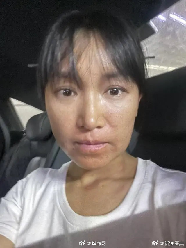 #李子柒学漆艺时脸部过敏照片#【李子柒学习漆艺曾经历严重过敏，照片曝光】#李子柒