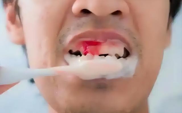 很多人都有过这样的经验：早晨刷牙时，看到牙刷上有一点点血，心里想着，这就是小问题