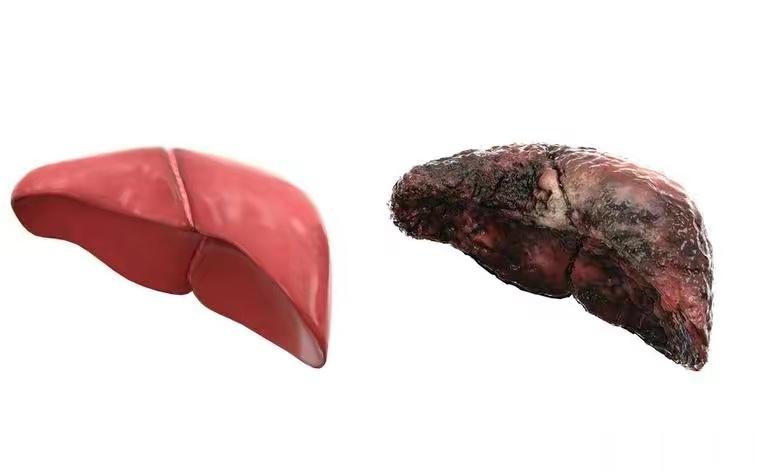 8大预警信号警惕肝硬化1、如果近期出现难以控制的低热并且伴有中性白细胞增高的话，