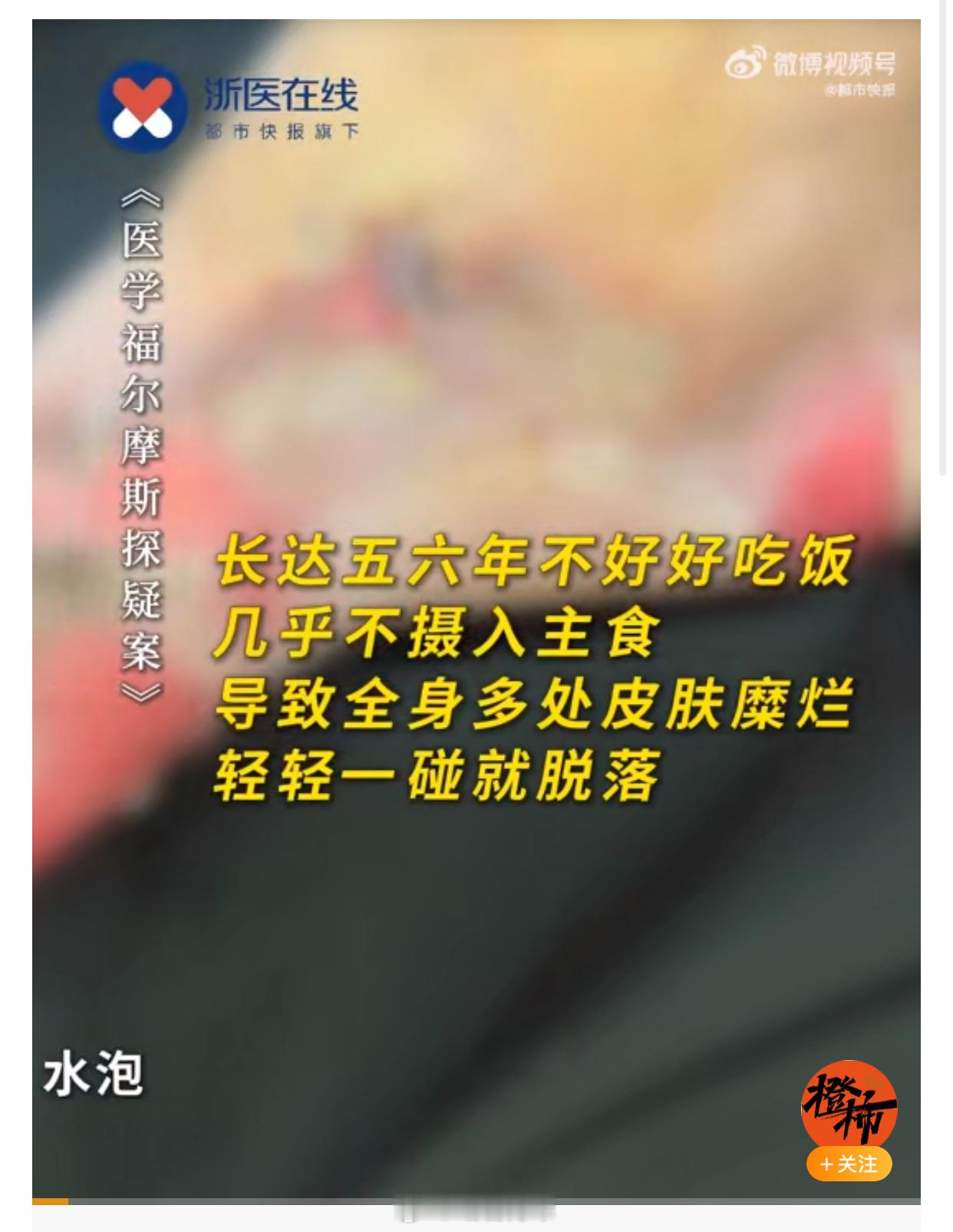 #大伯长期不吃主食全身多处皮肤糜烂#上一个比较知名的所谓的营养学专家、号称是国内