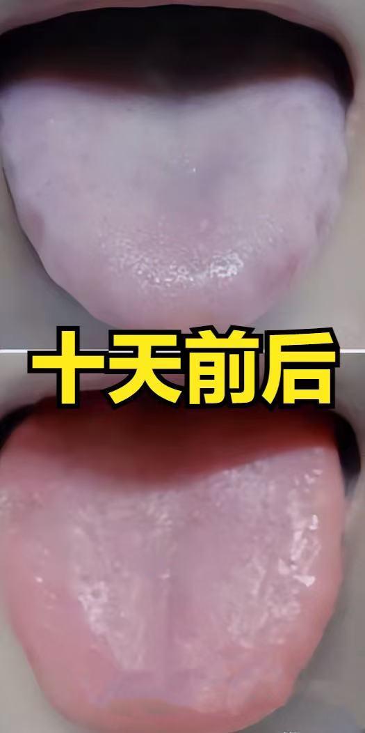 10天扫清齿痕舌！中医两步法：湿气去不掉？根本是第一步就错了！

患者主诉：体沉