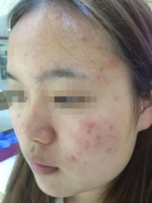 祛痘也能很简单
很多时候痘痘不一定就是上火引起，体寒也是重要原因，不要轻易用苦寒