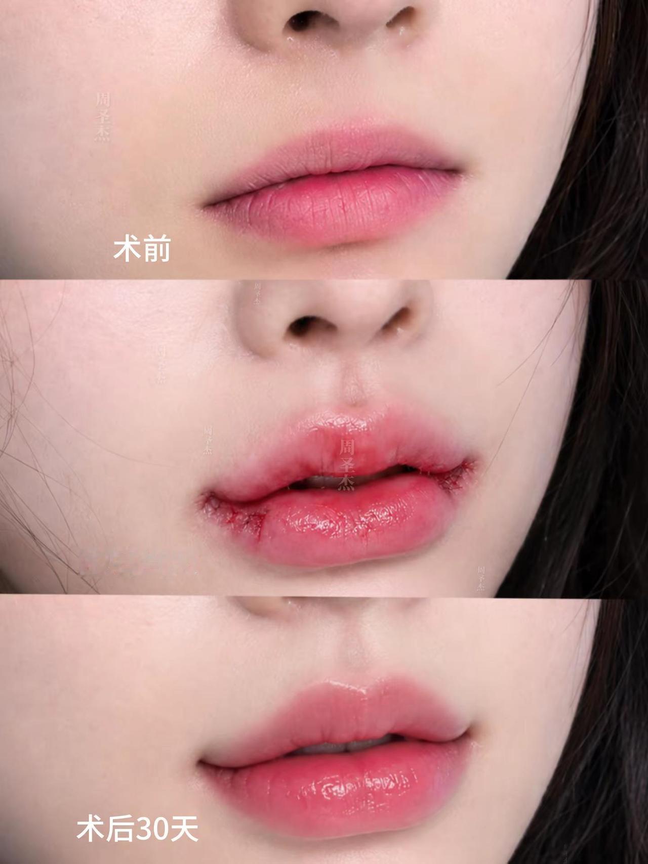 再也不会被人说整天板着个脸了微笑唇 嘴角上扬 唇部修复 打造妈生少女唇