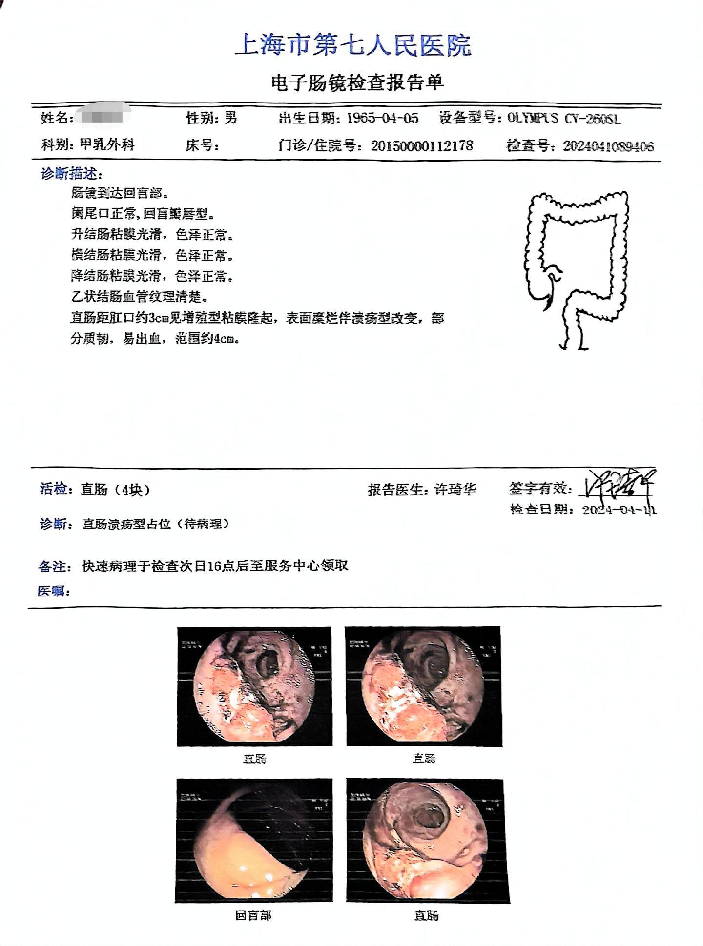 结直肠溃疡，不等于溃疡性结直肠炎。这位患者，一开始怀疑直肠肿瘤，但是病史已经6年了，两次病理活检都没有恶性的依据。
同时这个也不是溃疡性直肠炎。
目前最符合的孤立性直肠溃疡，可以由直肠黏膜脱垂，便秘，易于损伤等原因引起的直肠溃疡。