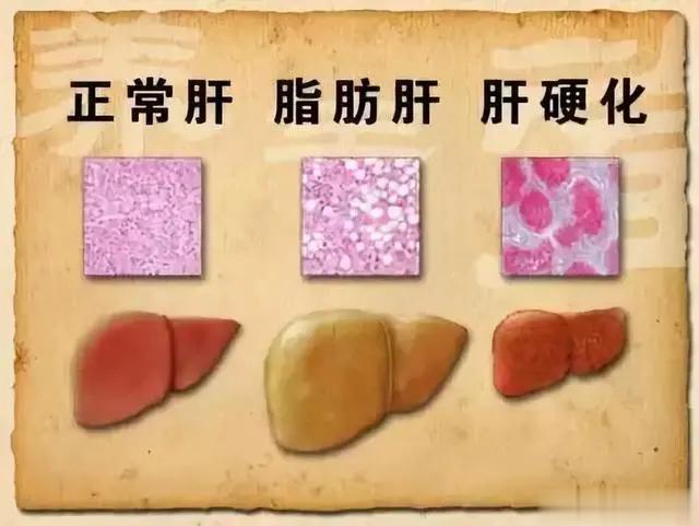 吃素也会得脂肪肝？关于脂肪肝的7个误区1. 吃素不会得脂肪肝很多人选择通过吃素来