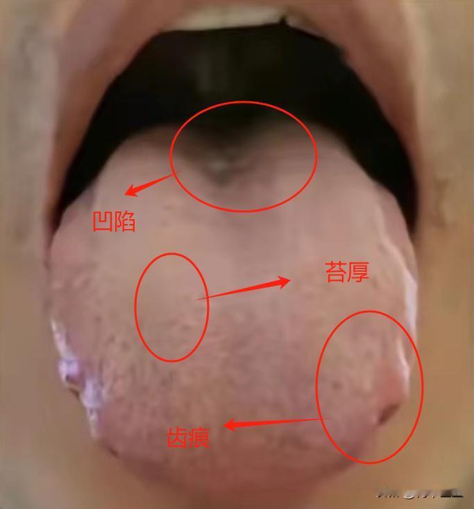 有这样的舌头要注意，这不是单单的脾虚，是肾阳虚

今天看诊了这样一位患者，他说自