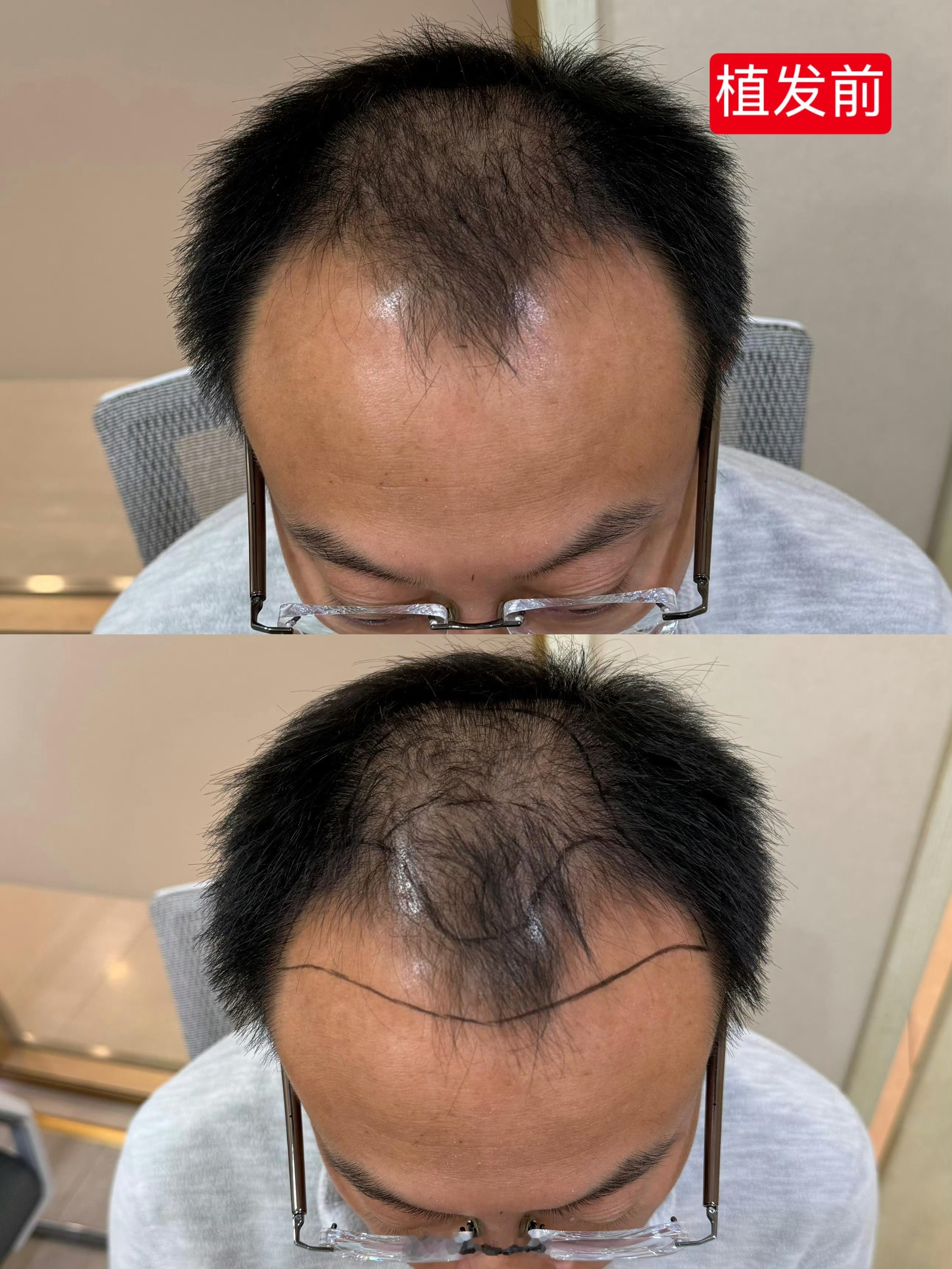 植发一个月体验：现在的发际线已经和原生发自然融合，拍照时完全看不出痕迹，发量肉眼