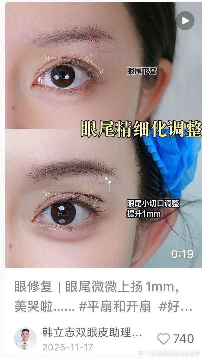 这种眼尾1mm提升技术谁做的好啊 