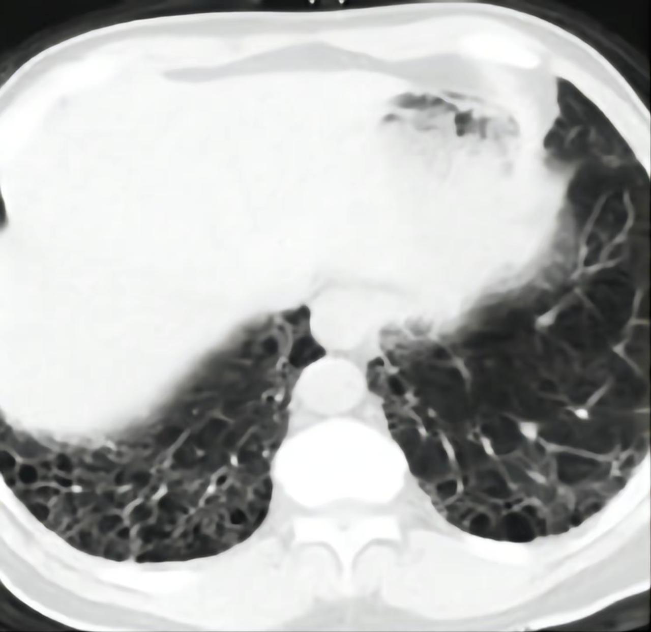 前阵子检测接诊了一个患者，让我心心里忍不住发酸，报告出来的时候，我不知道该怎么给