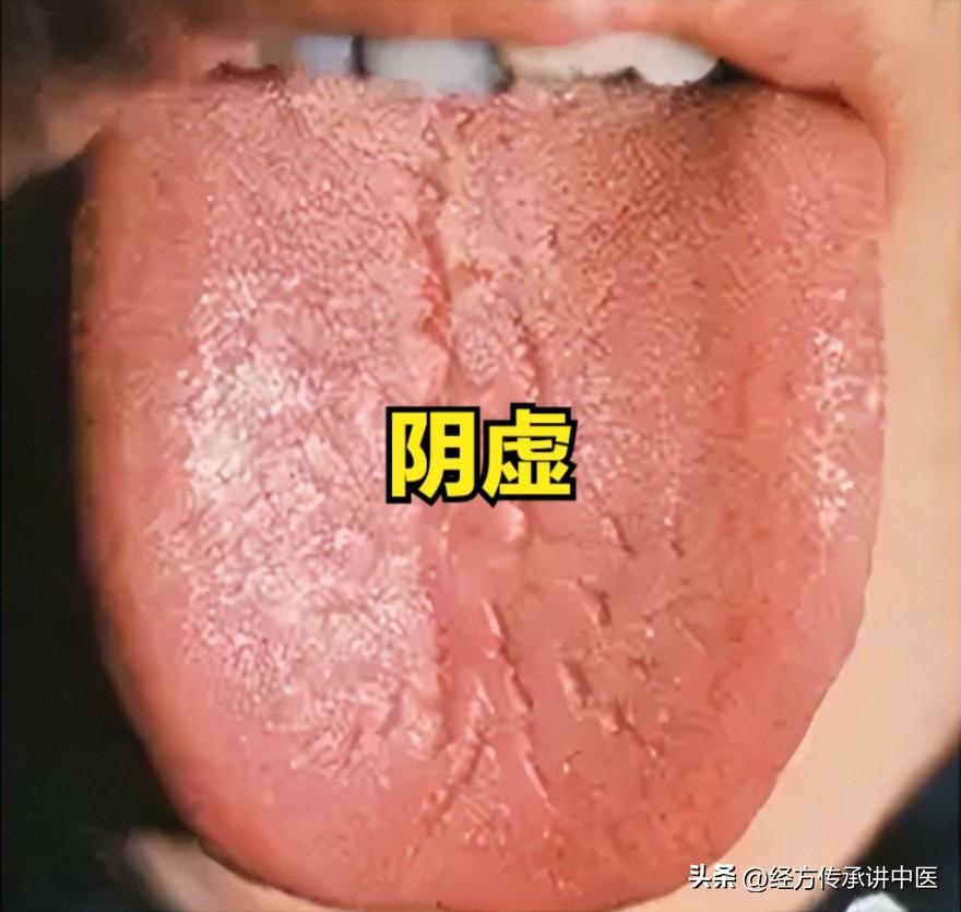阴虚—便干，阳虚—便稀，气血虚—便秘，这三古方，让你便个通畅

1、阴虚——便干