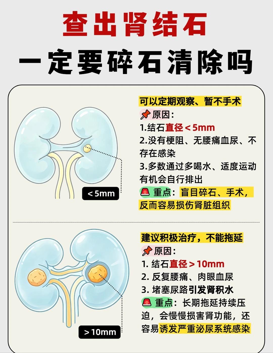 查出肾结石一定要碎石清除吗？