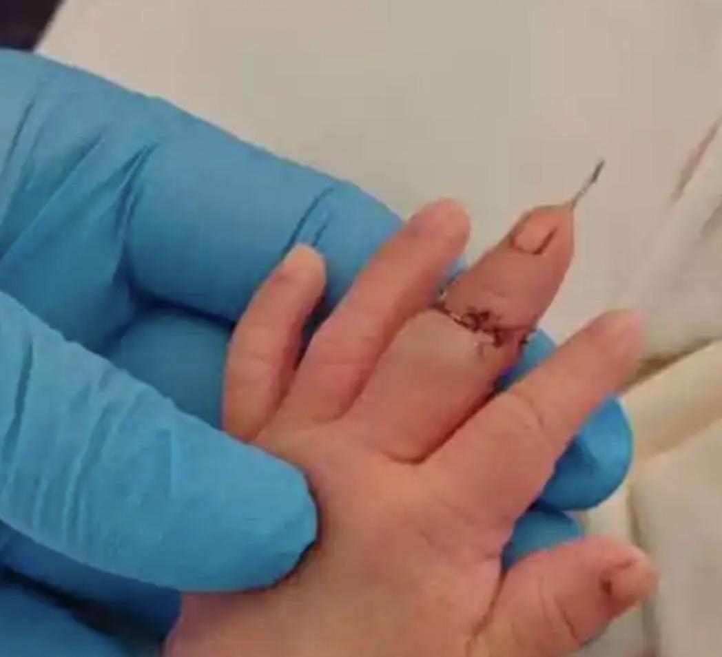 一名专业的助产士，竟然在给新生婴儿剪脐带时，把对方的手指给剪断了，这听起来像是天