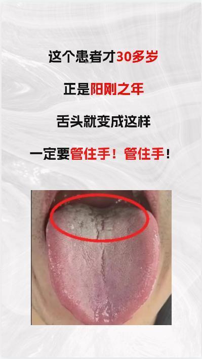 年纪轻轻，才三十多岁，正是阳刚之年，舌头竟然变成这样，一定要管住手！！！