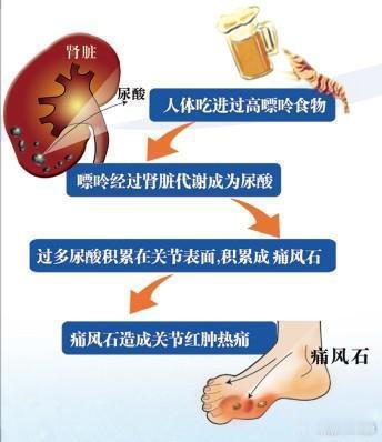 #痛风为啥重男轻女##世界痛风日# 【如何预防痛风】1⃣️减少饮酒。酒里面含有酒