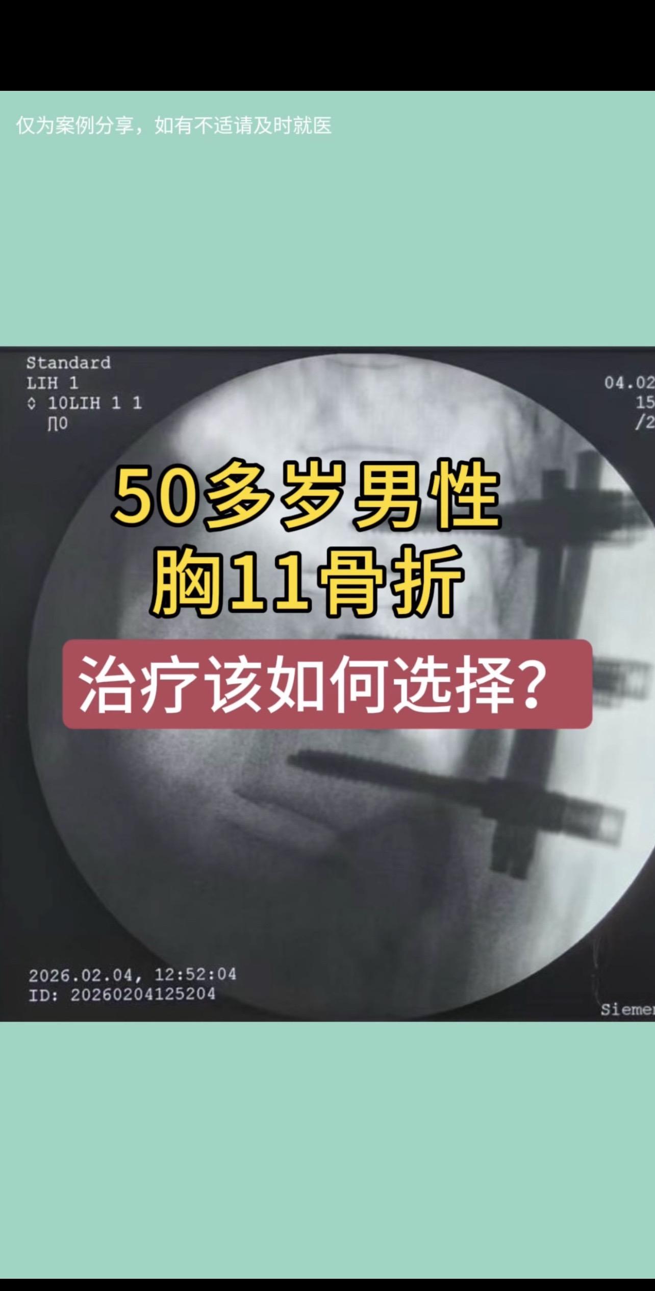 50多岁男性，胸11压缩骨折，术中撑开后，椎体高度恢复佳。