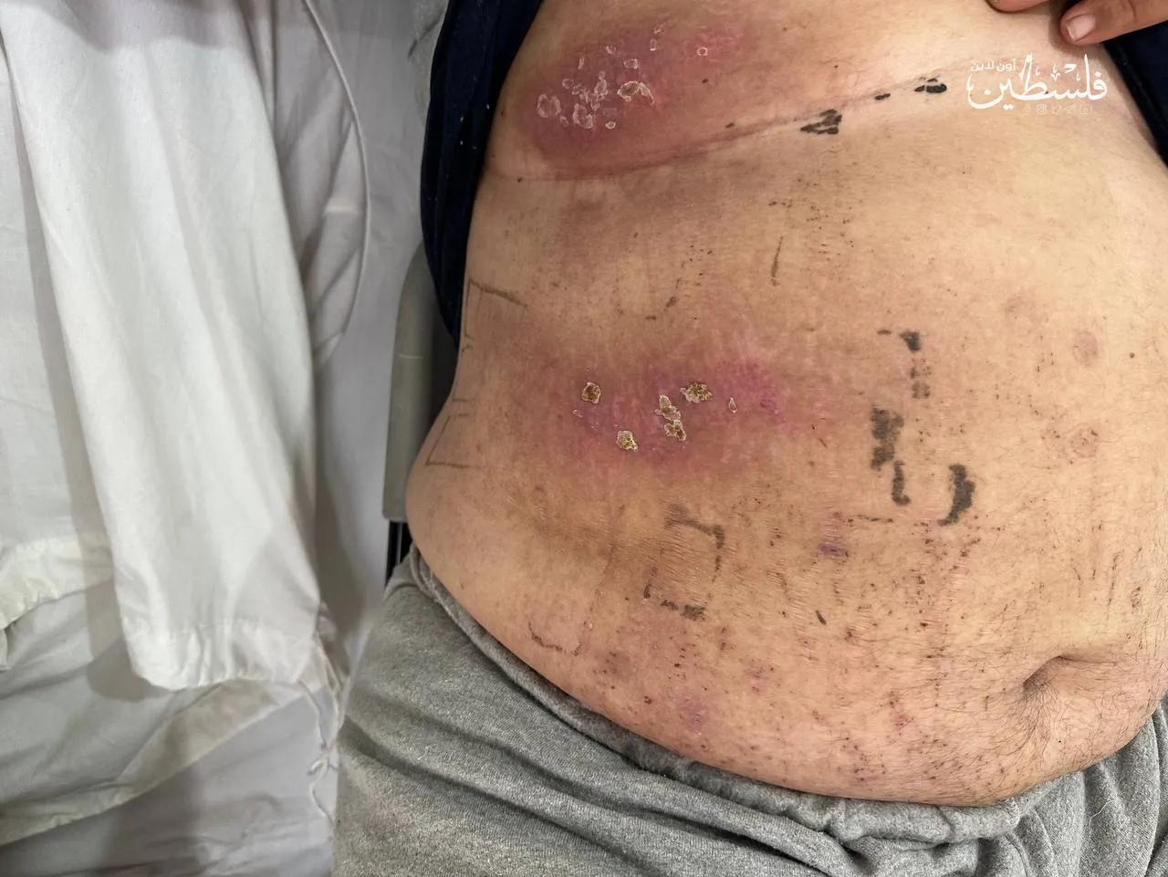 今天上午，以色列军方释放了一批从加沙被绑架的巴勒斯坦平民，他们的尸体上有严重酷刑