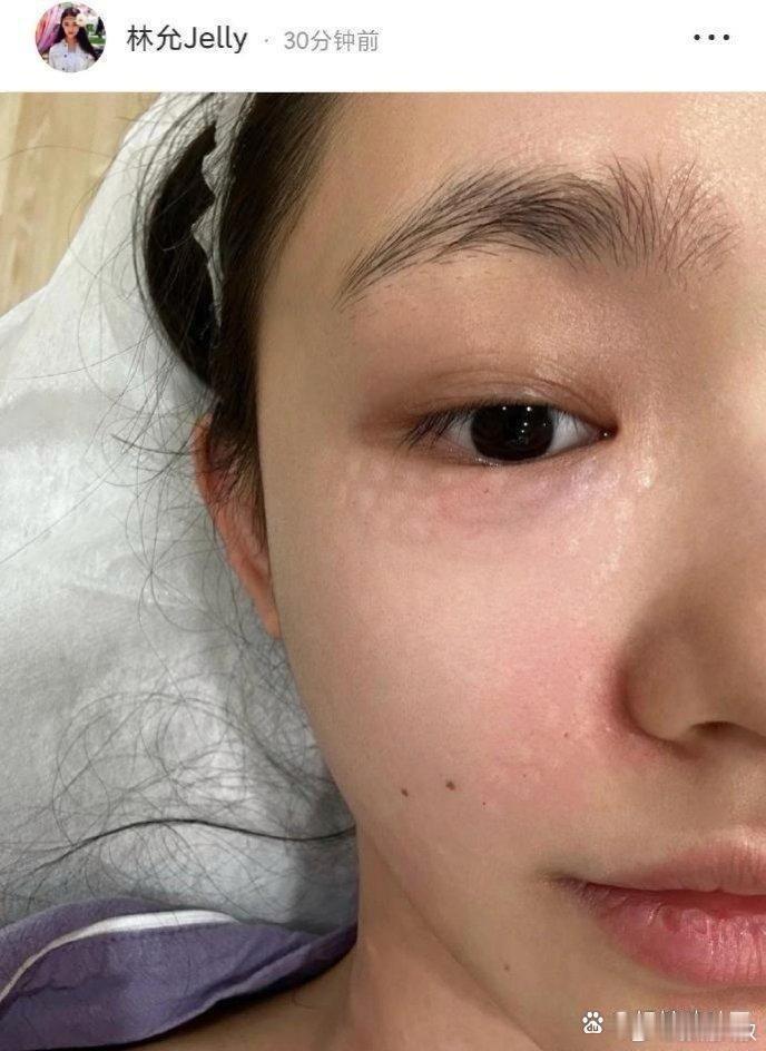 林允27岁开始打胶原蛋白，防止皱纹。脸上针眼密布，可见医美需谨慎啊。年纪轻轻就如