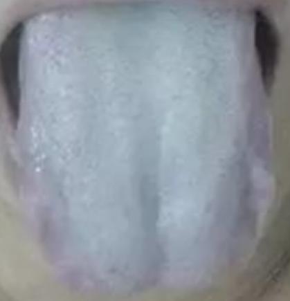 用附子，肉桂，干姜大热药没效！典型的虚不受补！

患者症状： 比较怕冷，食欲不振