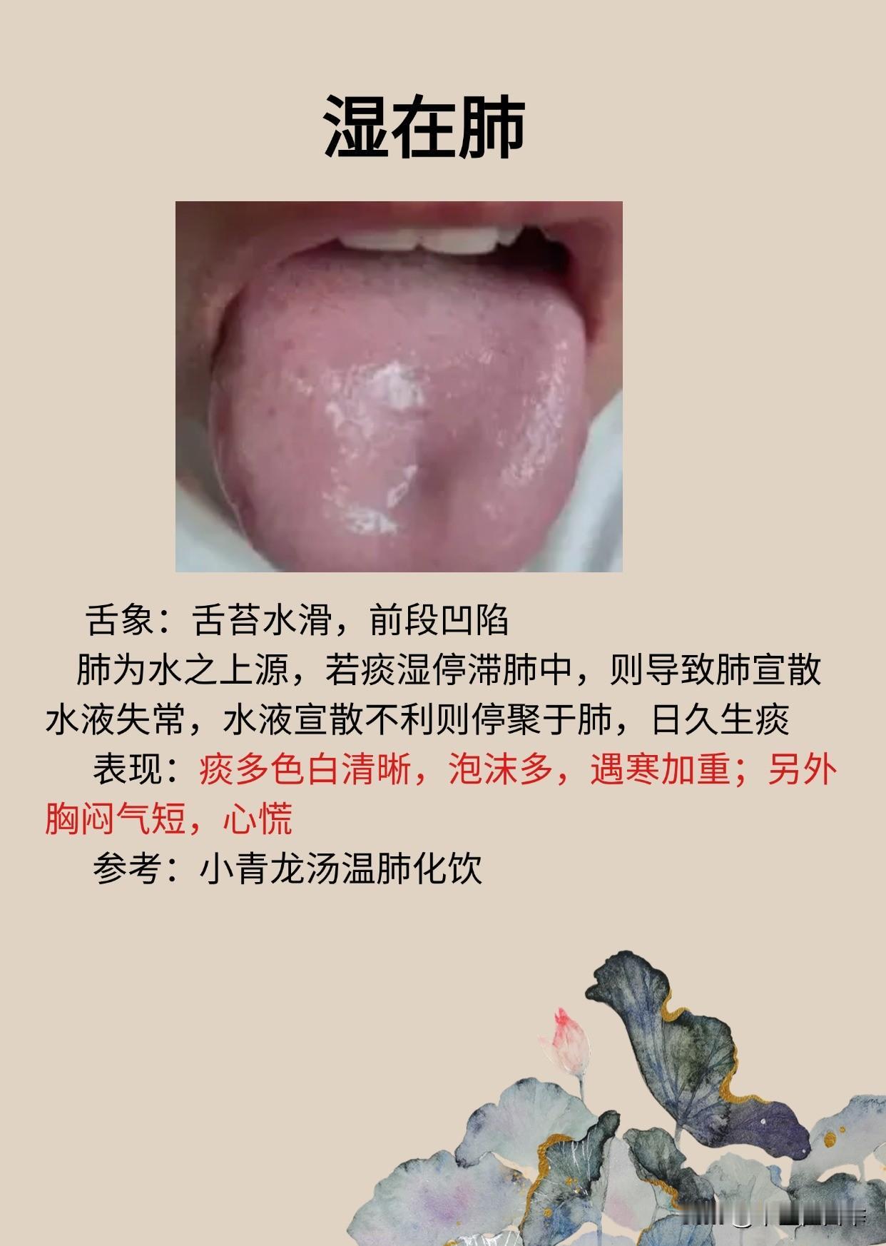 湿在上焦（肺）痰多、湿在中焦（脾）腹胀、湿在下焦（肾）微软，三个仲景方，精准清理